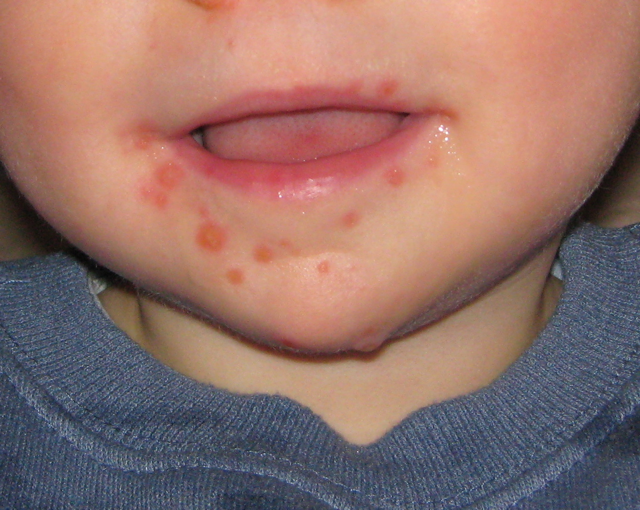 Lesions caused by the hand, foot and mouth virus.