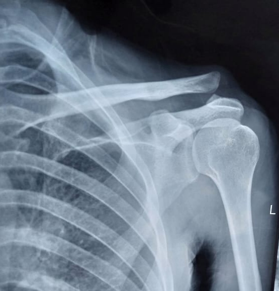 <p>Acromioclavicular Joint Disruption</p>