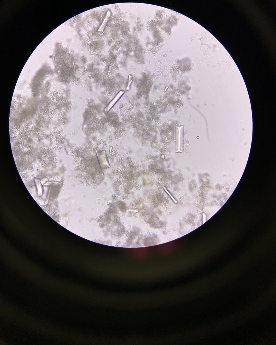 <p>Amorphous Phosphate and Triple Phosphate Crystals in the Urine