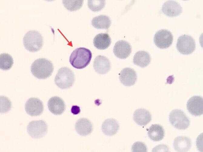 Cabot ring in the red blood cells.