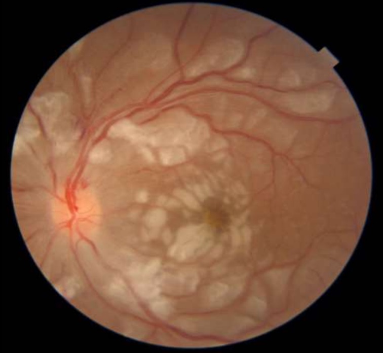 Purtscher-like retinopathy in systemic lupus erythematosus (SLE) [note peculiar perivascular clearing]