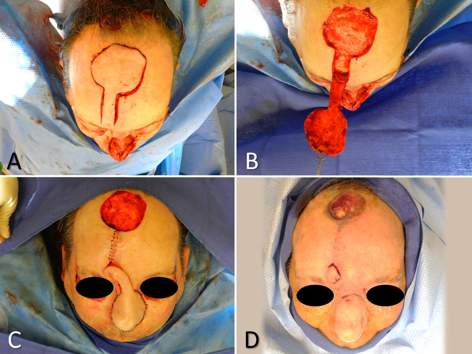 <p>Paramedian Forehead Flap for Nasal Reconstruction