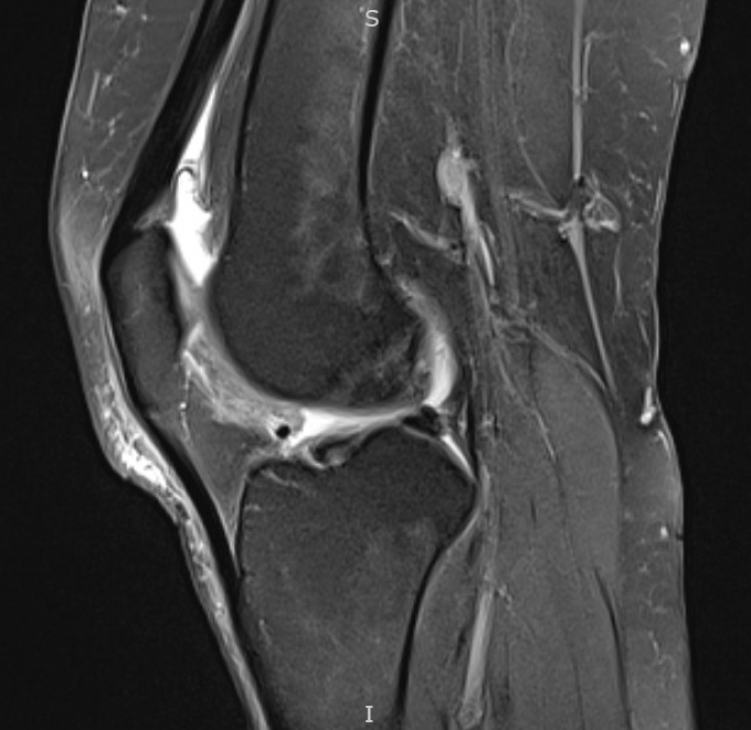 <p>Hoffa Pad Impingement Syndrome, MRI</p>