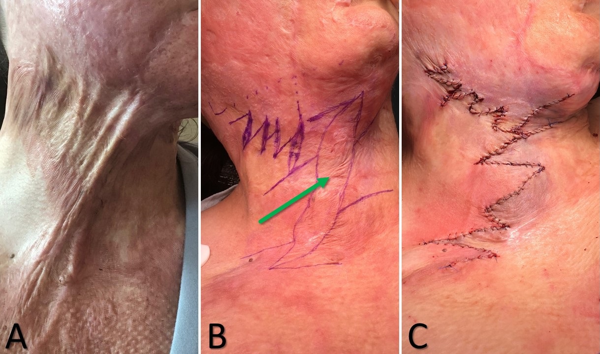 Running z-plasties performed to release scar banding due to a burn injury; the large scar band (indicated by arrow) was resected prior to tissue rearrangement