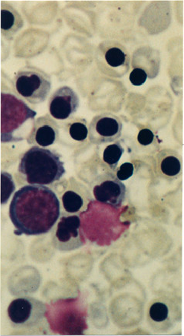 <p>Peripheral Blood Smear for a Case of Hydrops Fetalis