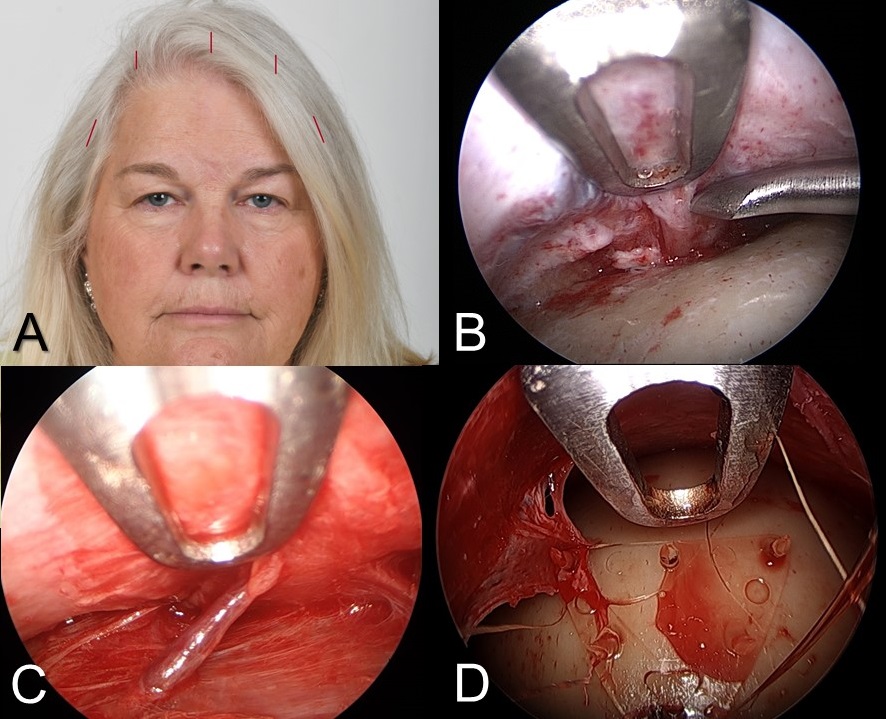 Endoscopic brow lift: A) Location of 5 incisions around the frontotemporal scalp