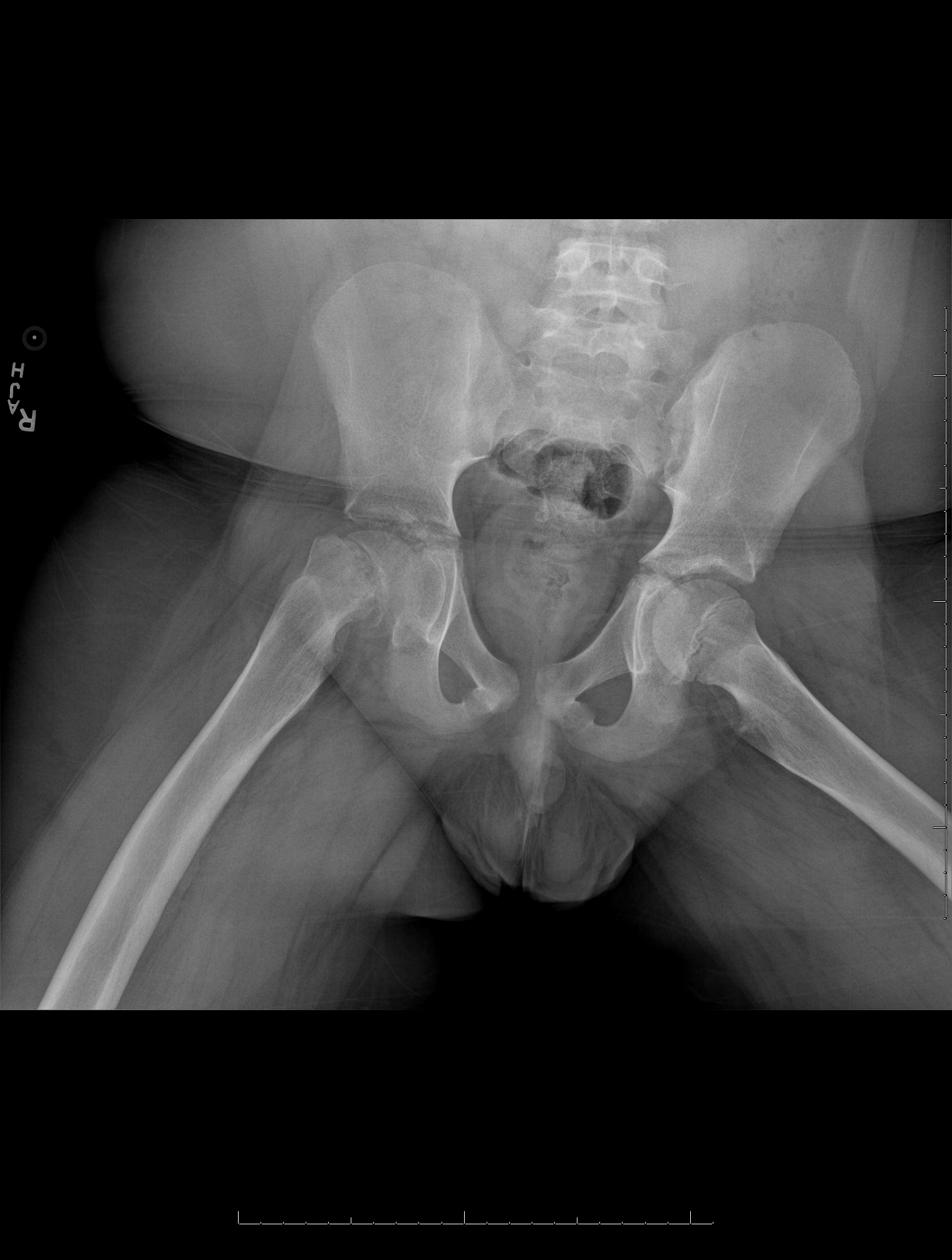 Frog leg view of the pelvis showing a right slipped capital femoral epiphysis which is a Salter-Harris type I injury