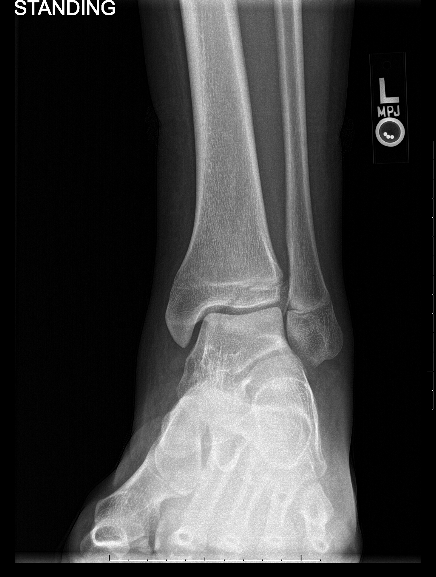 Oblique view of the ankle demonstrating a lucency at the anterolateral aspect of the distal tibial epiphysis consistent with 