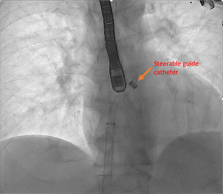 <p>MitraClip and Steerable Guide Catheter