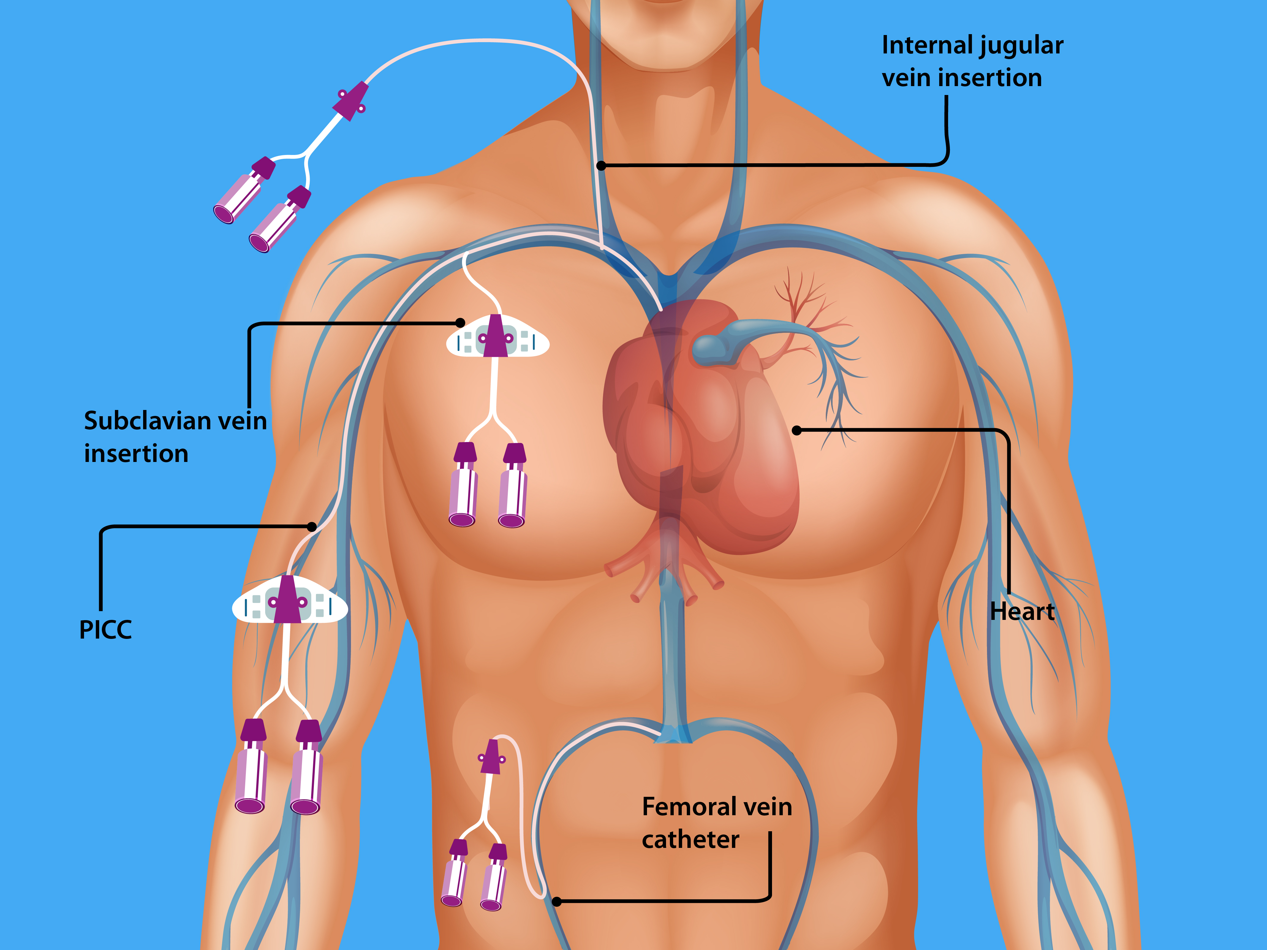 <p>Central Venous Catheterization Body Access