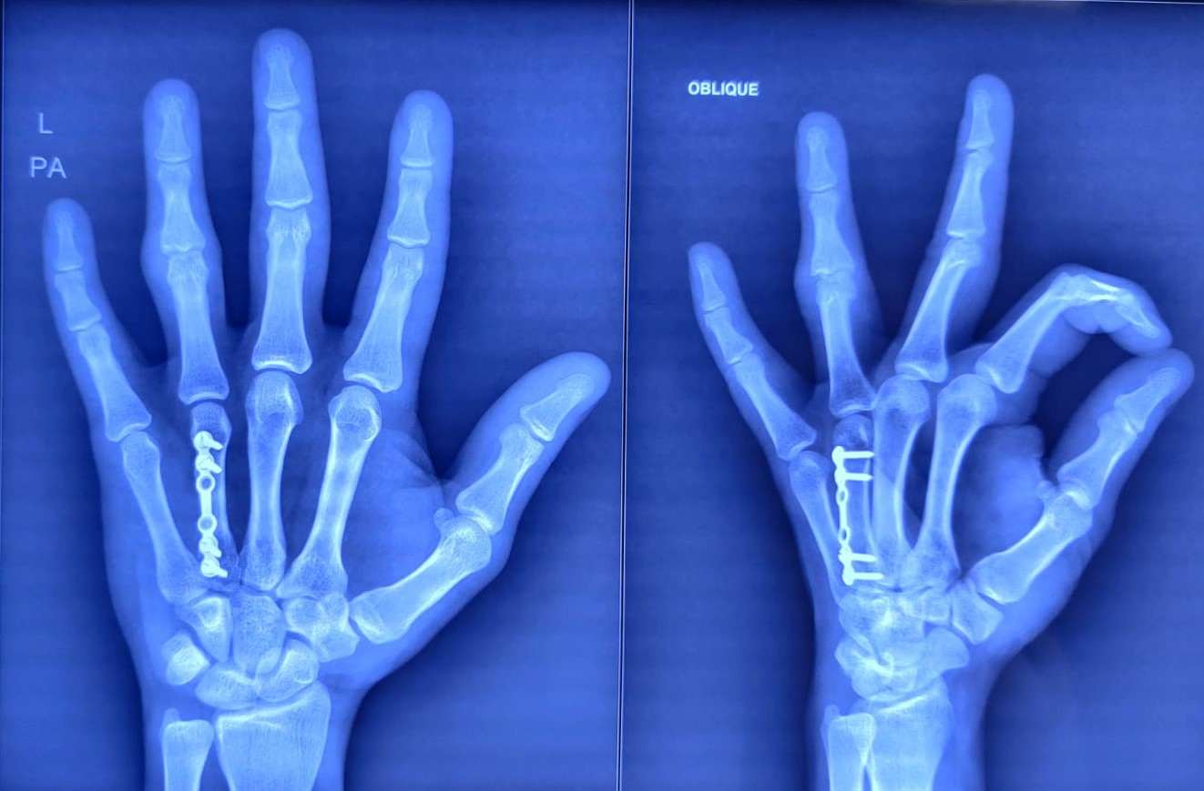 X-ray showing plate fixation for 4th Metacarpal fracture