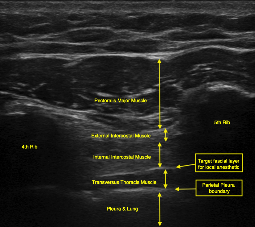 Proper sonographic view when performing a TTMPB