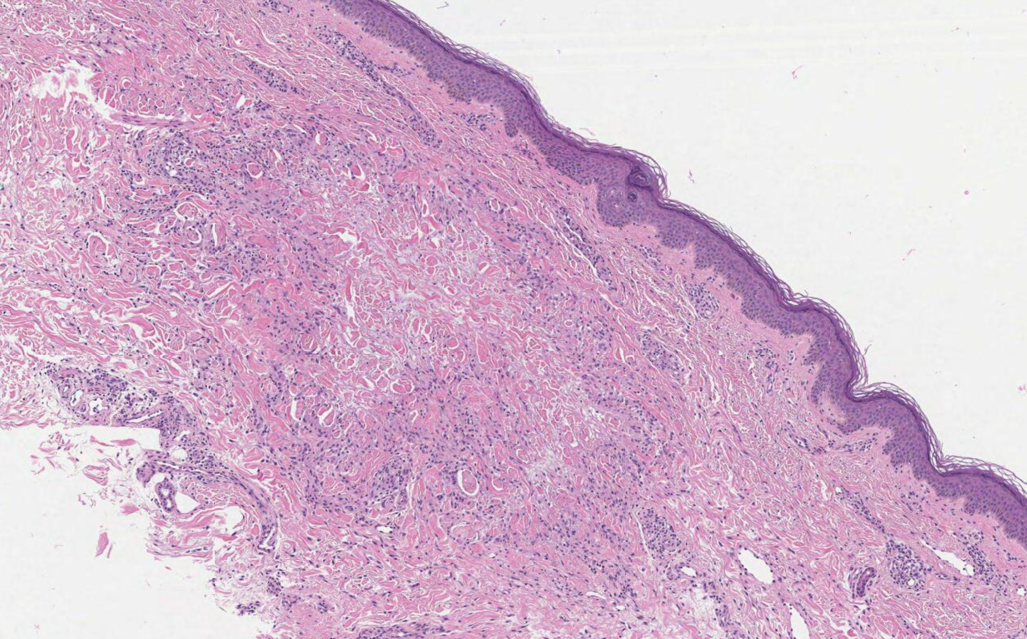 <p>Granuloma Annulare, High Power