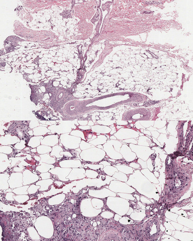 <p>Pancreatic Panniculitis Pathology