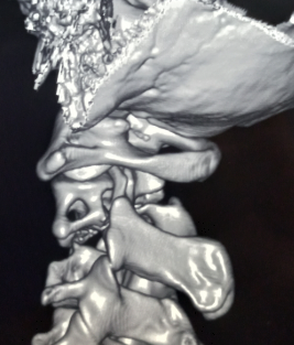 3D CT spine showing Hangman's fracture
