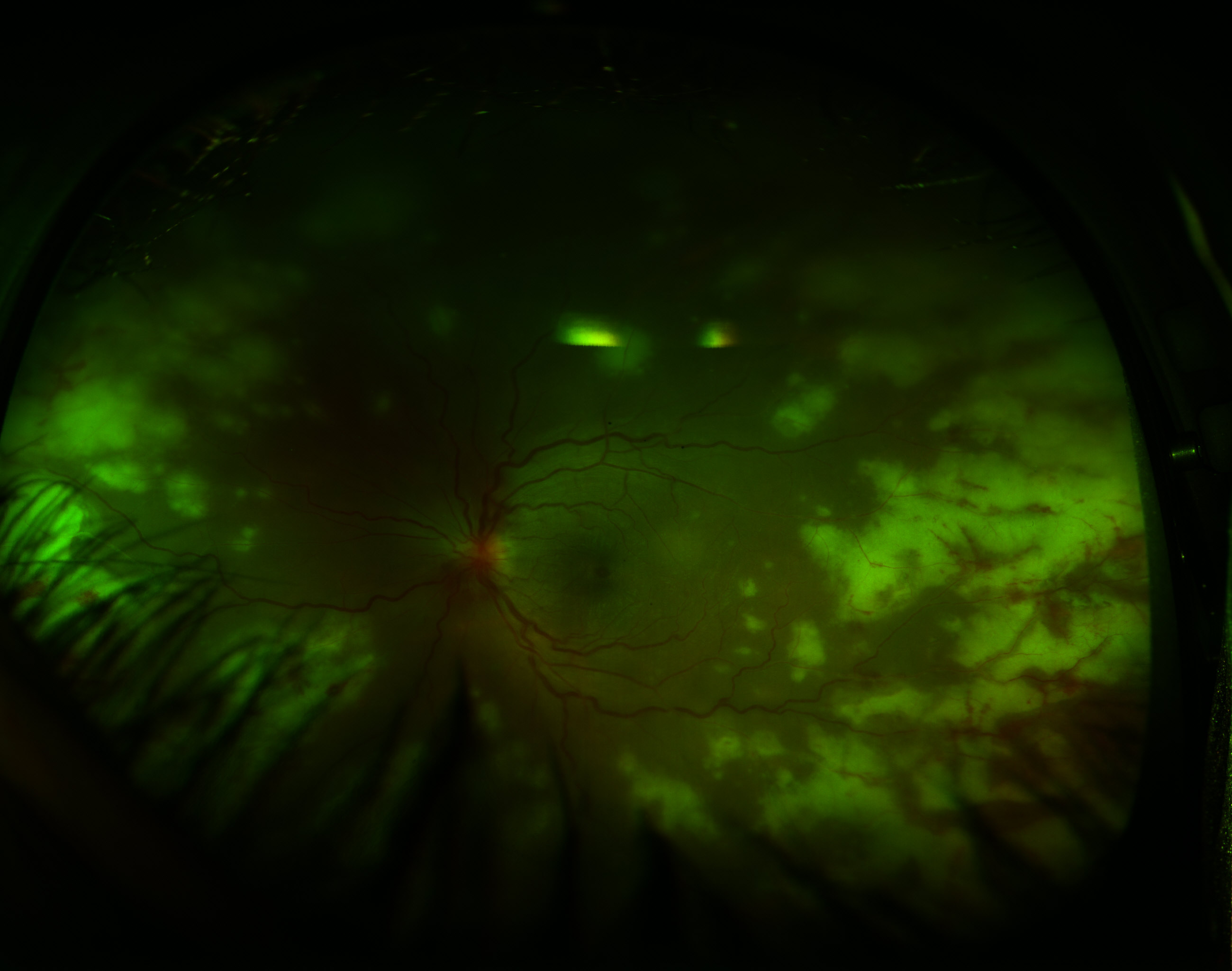 <p>Acute Retinal Necrosis