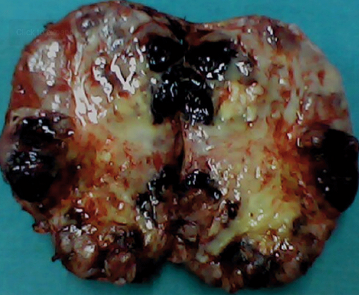 <p>Gross Specimen of a Giant Pheochromocytoma.</p>