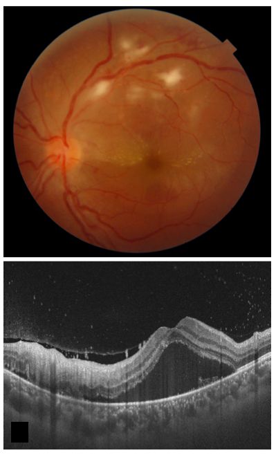 <p>Post-Fever Retinitis. This image shows macular edema and multiple white retinal lesions.</p>
