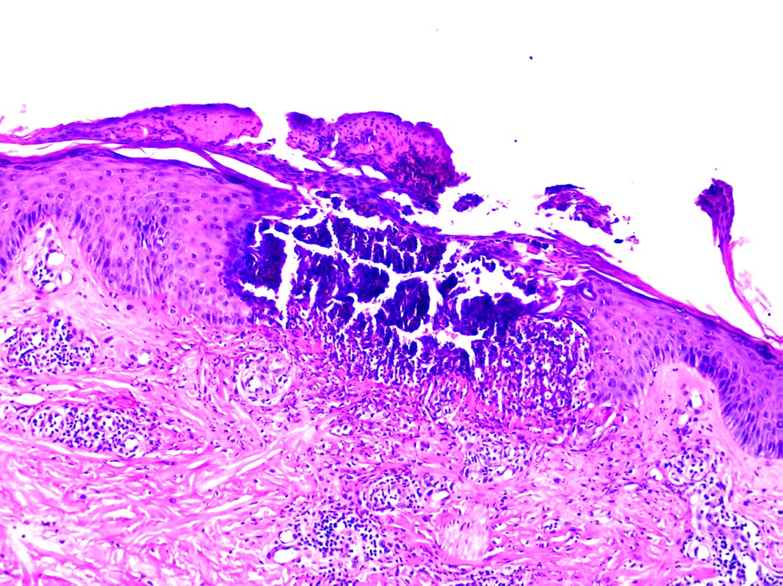 Perforating dermatosis demonstrating a cup-shaped invagination of the epidermis plugged with keratin, basophilic necrotic debris, degenerated collagen bundles, and neutrophils