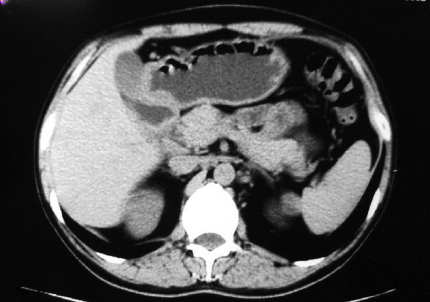 CT scan of abdomen with heterogenous enhancement of pancreatic head along with circumferential mural thickening of the second part of duodenum and mild fluid collection in pancreaticoduodenal groove