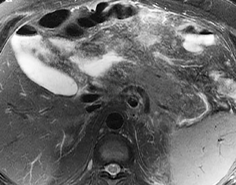 MRI abdomen showing fluid collection in the pancreaticoduodenal groove and fluid collection around the tail of the pancreas.