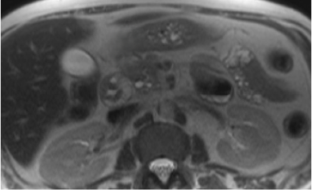 MRI of the abdomen showing thickening of the duodenal wall along with cystic changes.