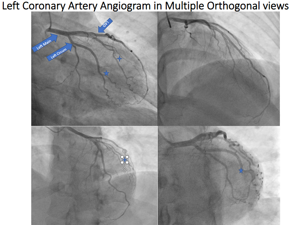 Left coronary angiogram in various orthogonal views