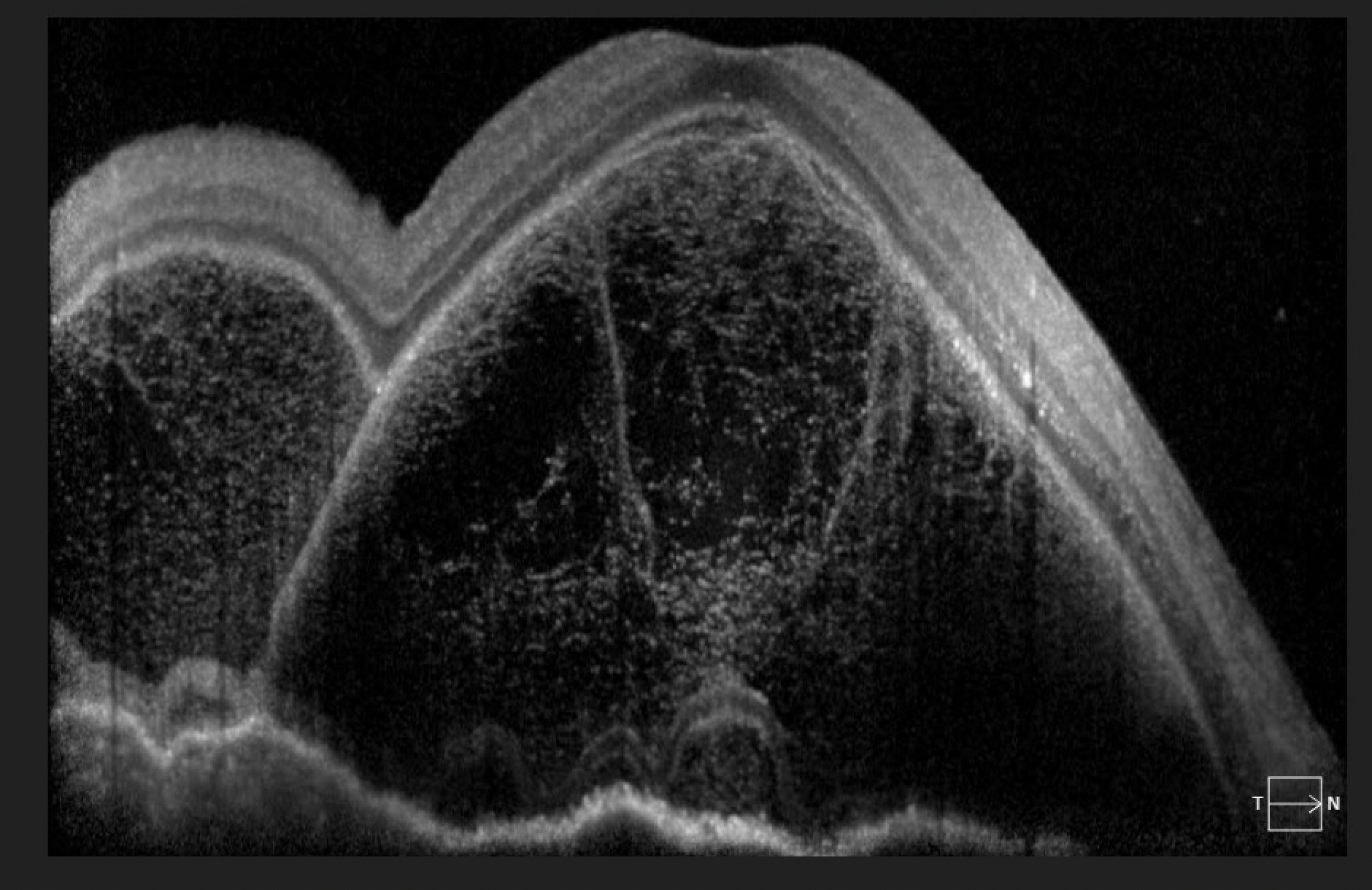 <p>Bacillary Layer Detachment. Optical&nbsp;coherence tomography image of bacillary layer detachment.</p>