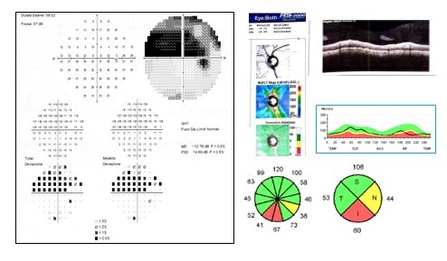 Visual field and Optical Coherence Tomography (OCT) results in a patients with open-angle glaucoma