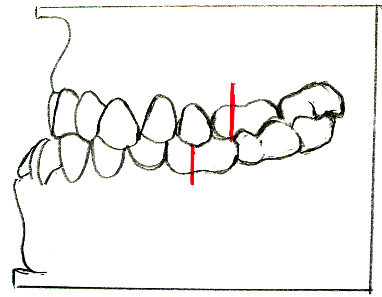 Angle class III molar relationship.