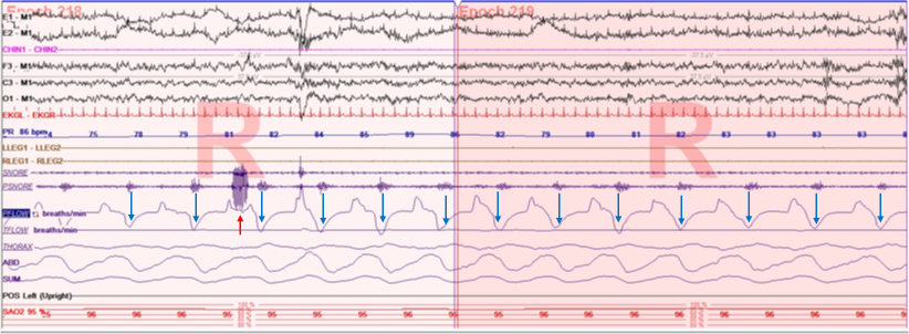 Polygraph demonstrates two type of flow limitation and snoring; expiratory (blue arrows) and inspiratory (red arrow) during REM sleep