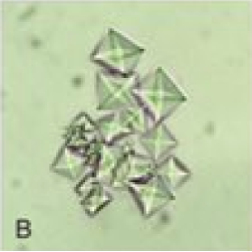 <p>Calcium Oxalate Dihydrate Crystals