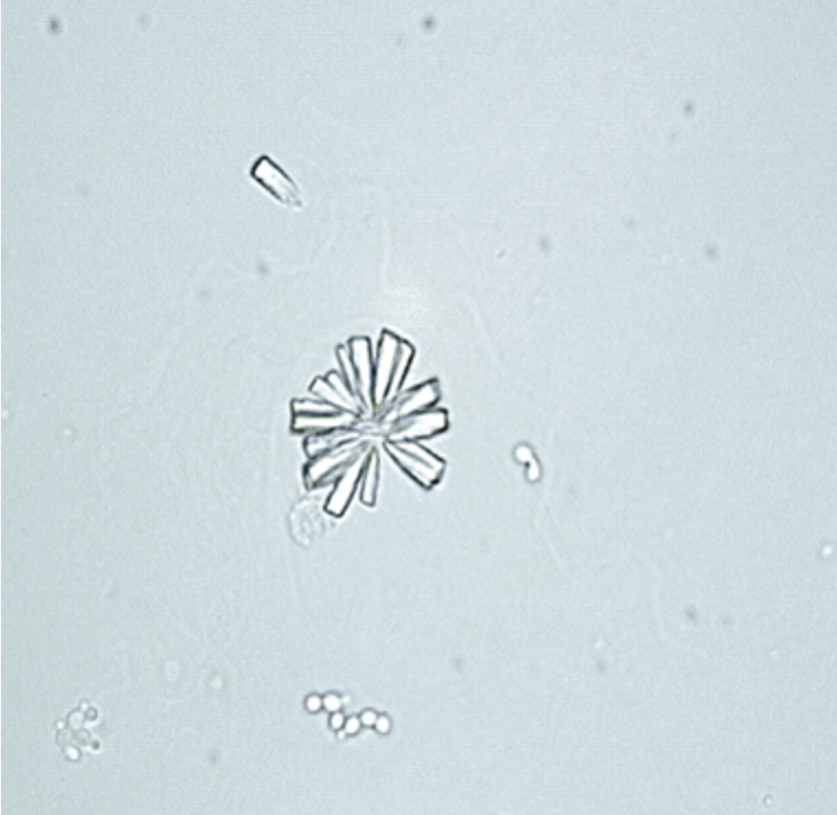 <p>Calcium Phosphate Crystals