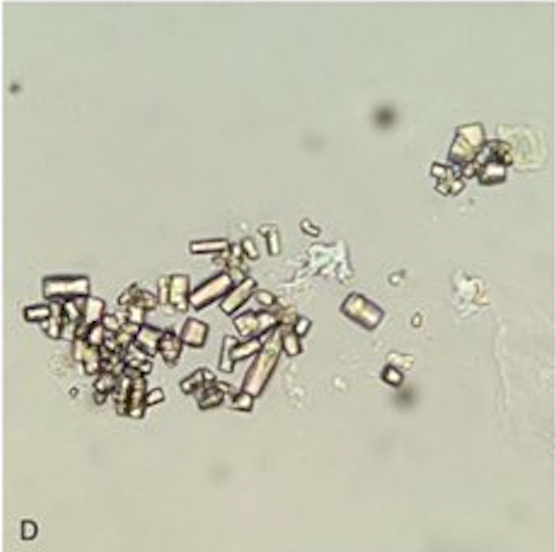 <p>Uric Acid Crystals, Barrel-Shaped. The image shows barrel-shaped uric acid crystals on light microscopy.</p>