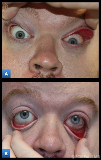 Floppy Eyelid Syndrome: Marked laxity of the upper and lower eyelids, which is usually asymmetric, with the side the patient sleeps on worse