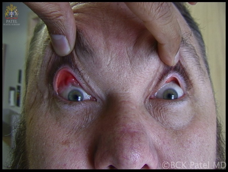 Floppy Eyelid Syndrome: the findings of eyelid laxity are almost always asymmetric, with the side that the patient sleeps on being worse, as illustrated here