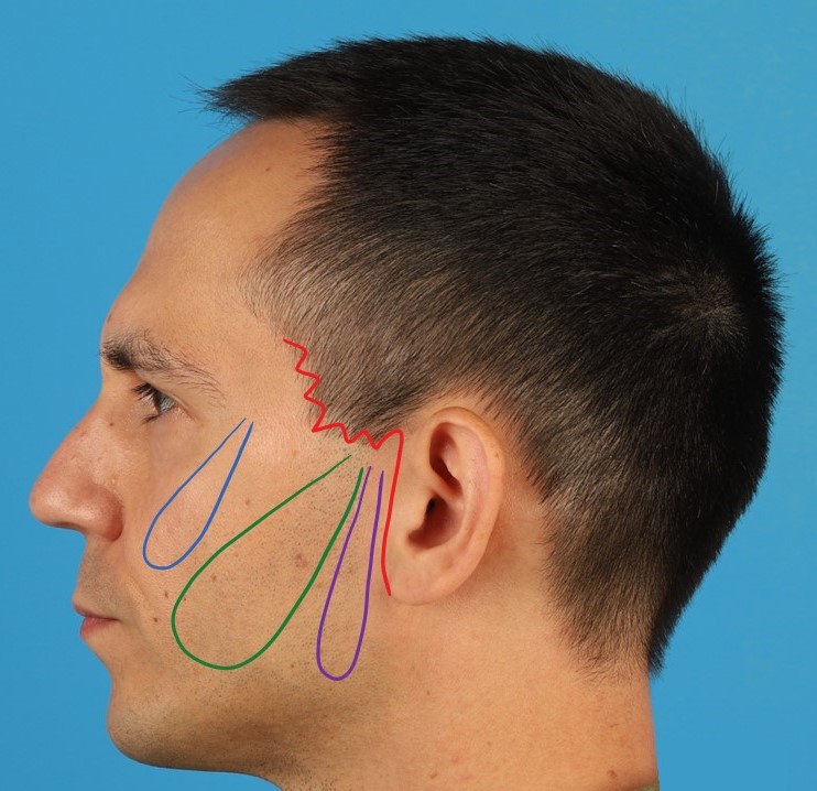 <p>Minimal Access Cranial Suspension Facelift