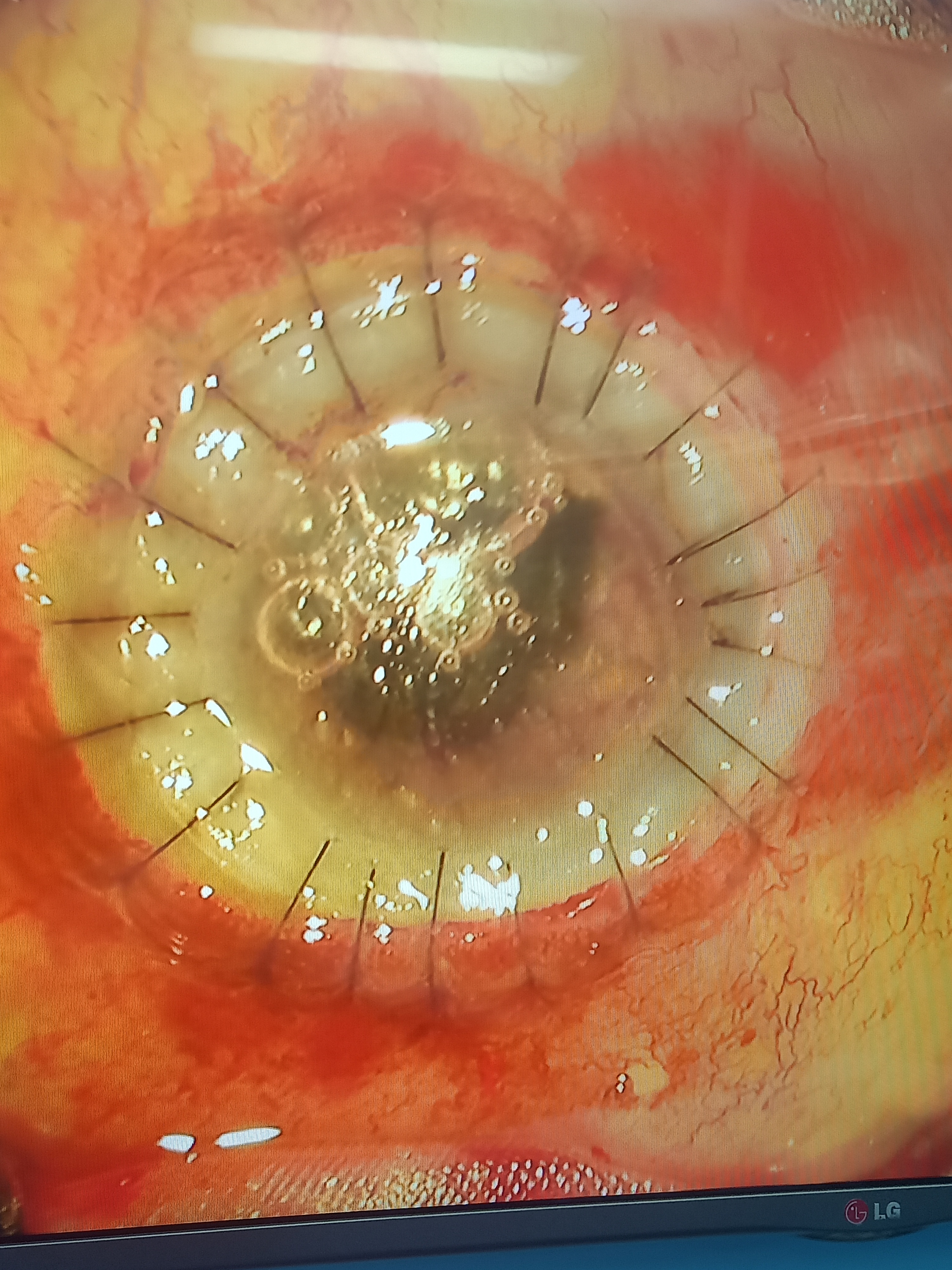 Digital image of the patient depicting well opposed graft in a case of perforate corneal ulcer post therapeutic keratoplasty