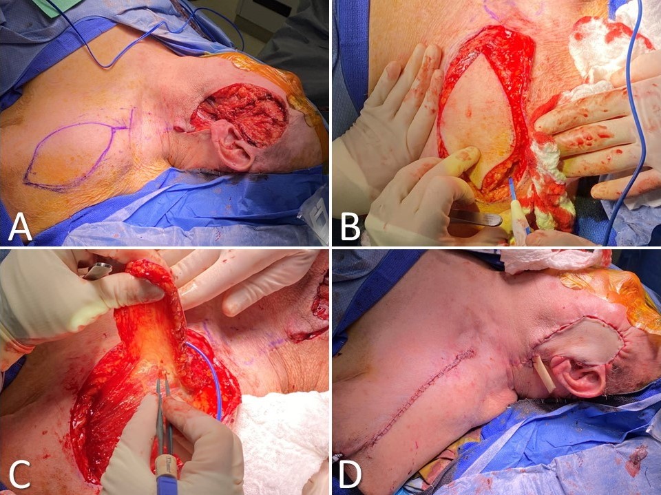 <p>Supraclavicular Artery Island Flap for Facial Reconstruction (SCAIF)