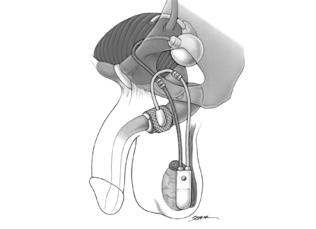 Schematic of an artificial urinary sphincter