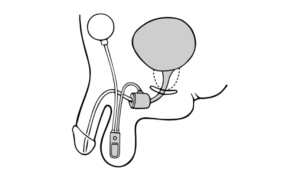 Urethra closed by cuff of the artificial urinary sphincter
