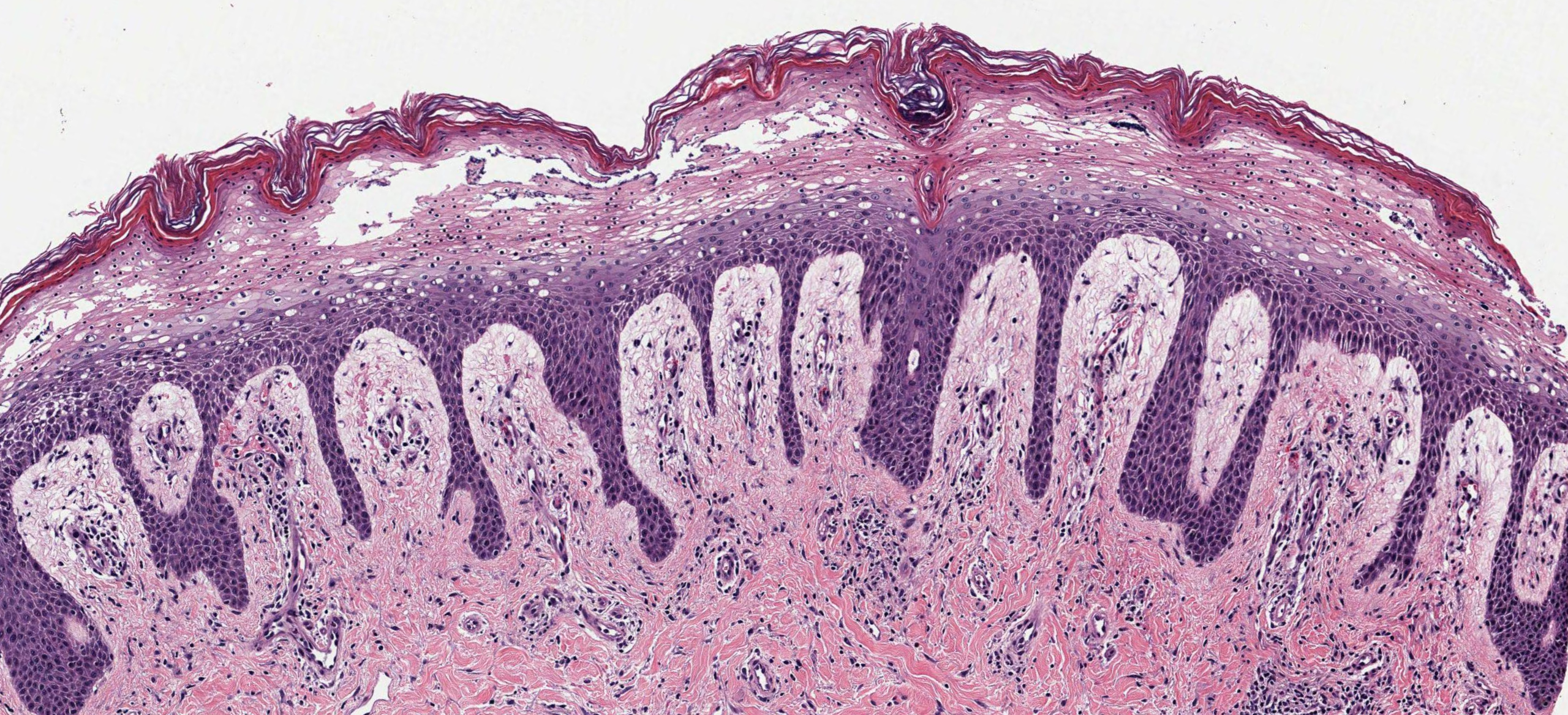 <p>Necrolytic Acral Erythema Histopathology