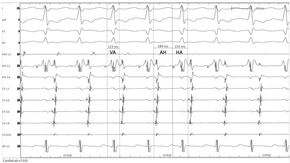 Atypical AVNRT. Atypical (slow-slow) atrioventricular nodal reentrant tachycardia (AVNRT). VA time > 60 ms. AH:HA > 1