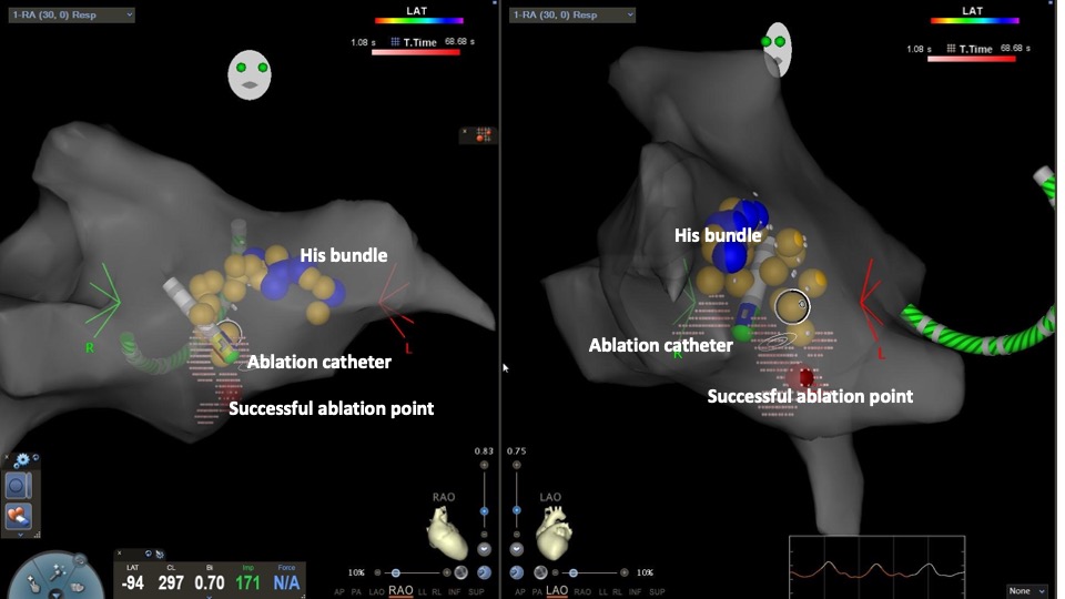 3-dimensional Reconstruction of the Right Atrium With the Use of CARTO Mapping System