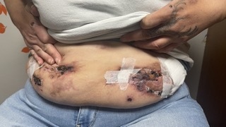 Xylazine-induced Abdominal Wounds