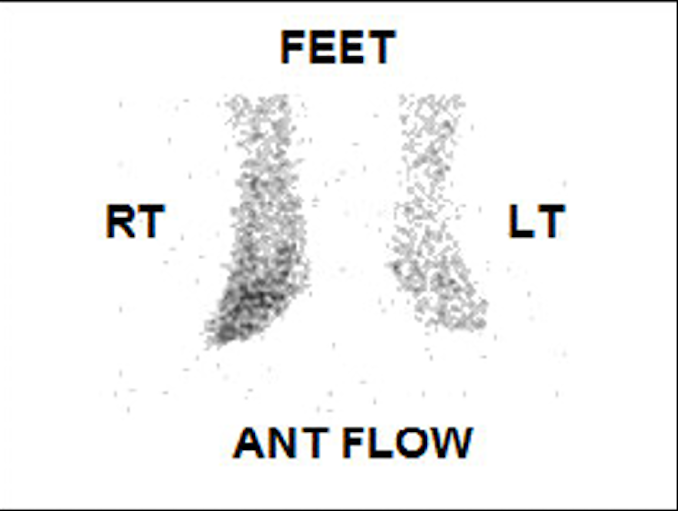 Three-phase Bone Scintigraphy: Flow Phase