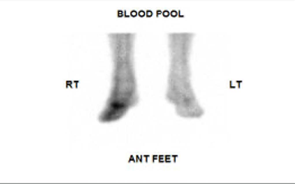 Three-phase Bone Scintigraphy: Blood Pool Phase