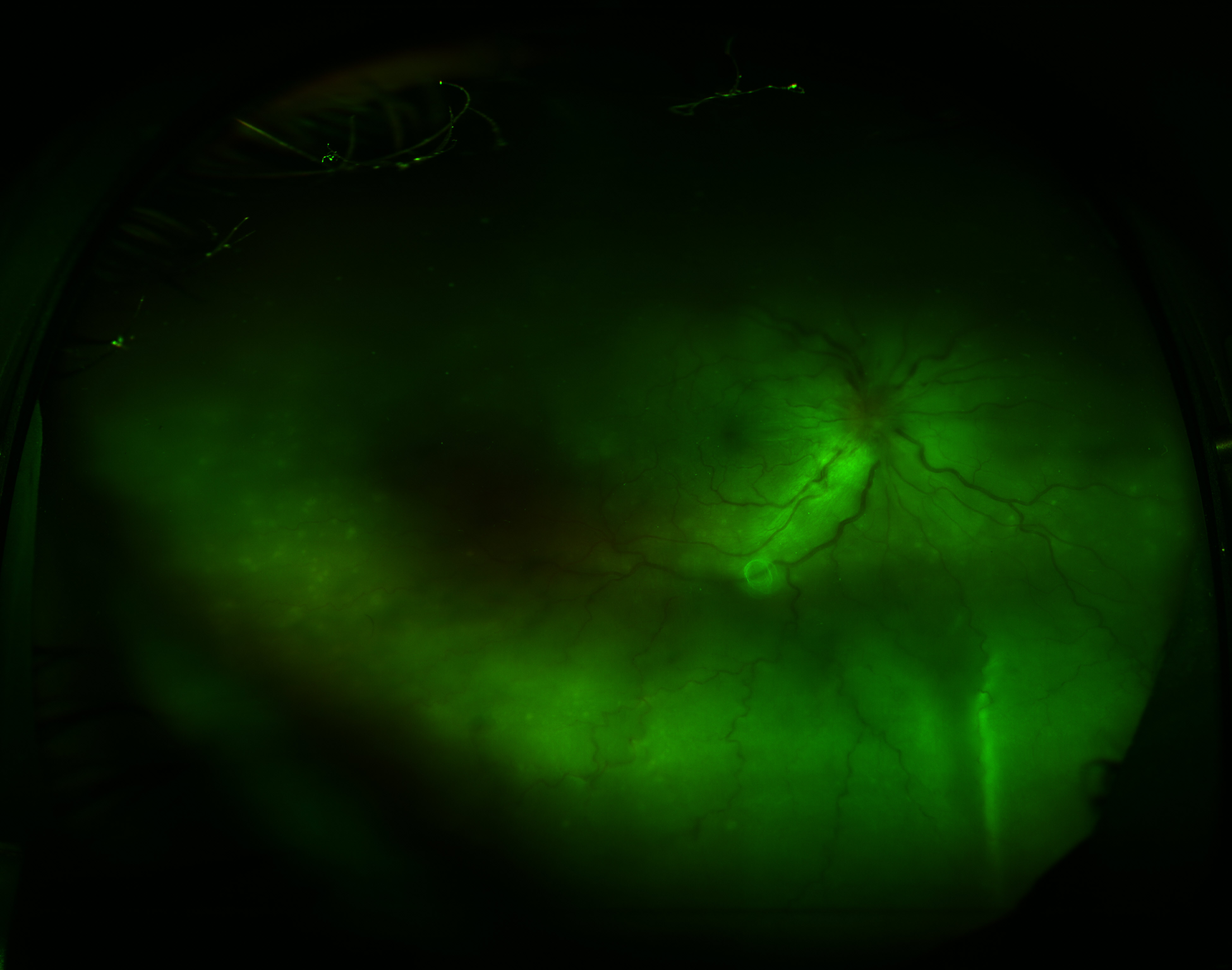 <p>Exudative Retinal Detachment. Image of retinal detachment in sympathetic ophthalmia.</p>