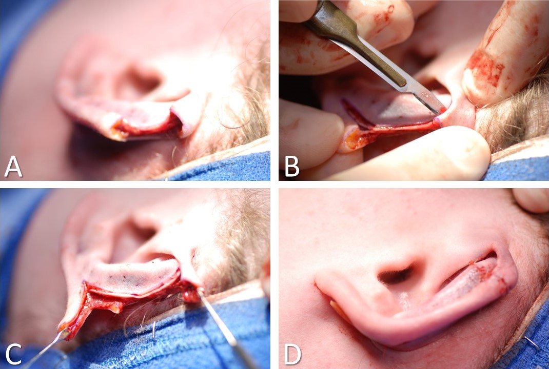 <p>Antia-Buch Helical Advancement Flaps for Auricular Reconstruction