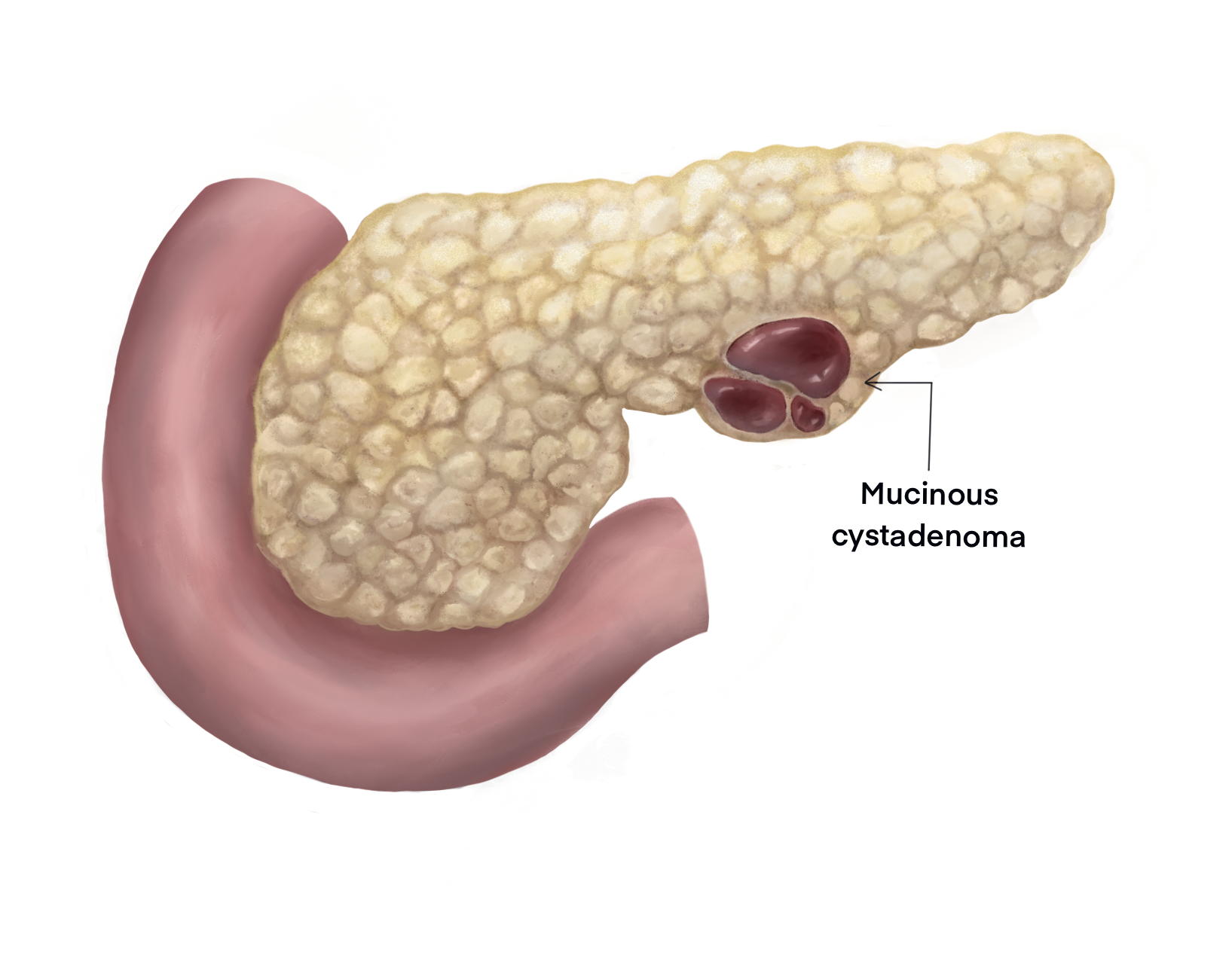 Illustration of mucinous cystadenoma